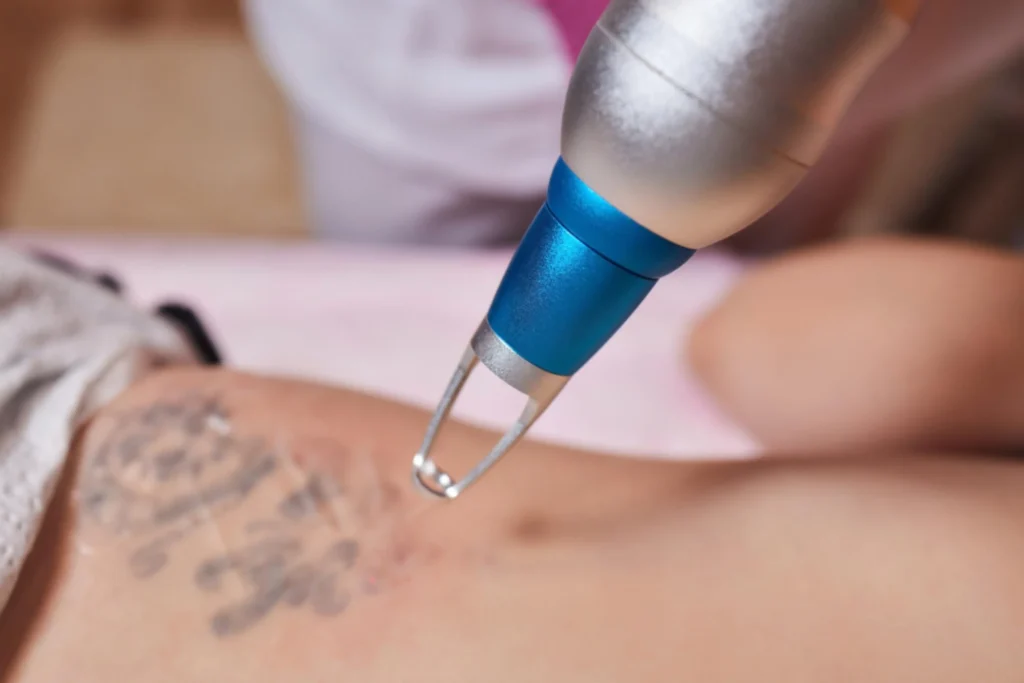 Détatouage